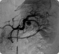 Imagem Angiográfica de um pseudoaneurisma de artéria esplênica (14)