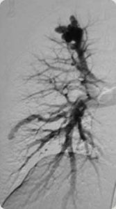 Imagem angiográfica da artéria pulmonar direita mostrando MAVB complexo no lobo superior e inferior. (17)