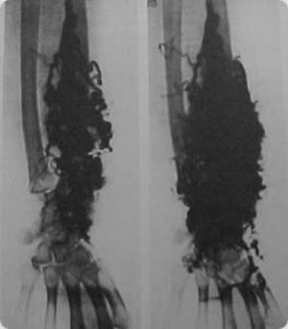 Imagem angiográfica de Mal formação capilaro-venosa em membro superior. (18)