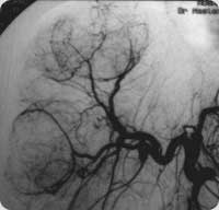 Imagem angiográfica de tumores hepáticos