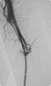 Imagem angiográfica de uma fístula arterio-venosa no território femoral esquerdo.