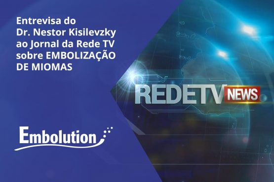 Entrevista Dr. Nestor no Jornal RedeTV News sobre -Tratamento de Mioma Uterino - Embolution