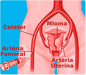 Como se processa a Cirurgia-de-embolização - Embolution - Passo 03