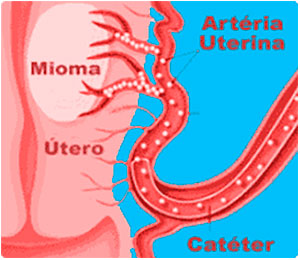 Como se processa a Cirurgia-de-embolização - Embolution - Passo 04