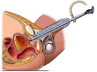 Esquema demonstrando a ressecção transuretral da próstata - Embolution