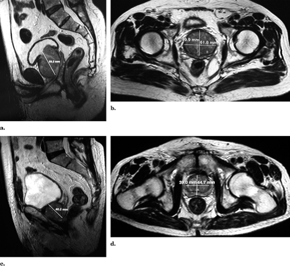 Ressonância Magnética da Pelve Masculina - Hiperplasia Prostatica - Embolution