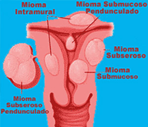 Mioma Uterino - Miomas - Embolution