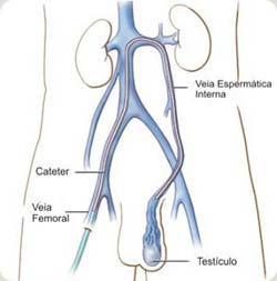 Varicocele - Embolution - Figura 01