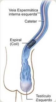 Varicocele - Embolution - Figura 02