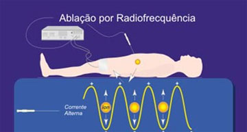 Funcionamento da Radiofrequencia - Embolution