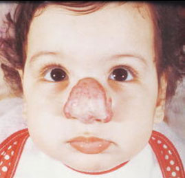 Hemangioma infantil em regiao nasal - Embolution