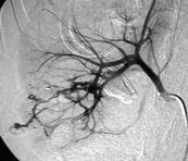 Hemorragia urologica provocada por um trauma-norim direito - 01 - Embolution