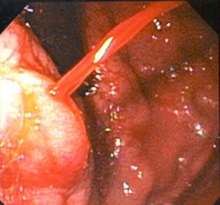 Imagem de um estudo por endoscopia - Embolution