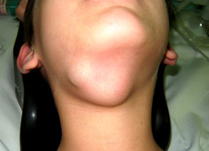 Linfangioma em região cervical - Embolution