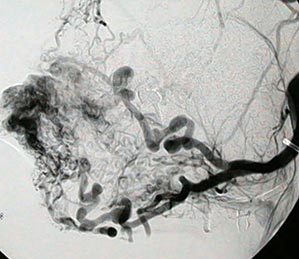 Malformação arterial localizada em região mandibular - Embolution