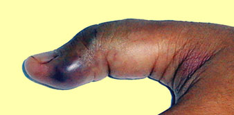 Malformação venosa no dedo da mão - Embolution