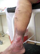 Úlcera de perna decorrente - Embolution
