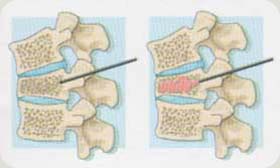 Vertebroplastia percutânea - Embolution