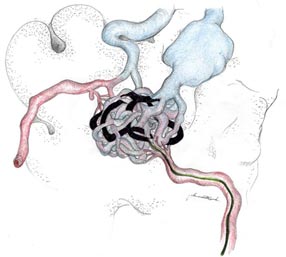 Malformações arteriais 01 - Embolution