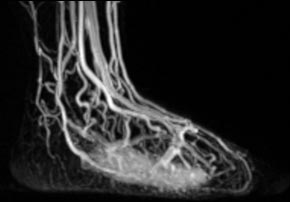 Malformações arteriais 02 - Embolution