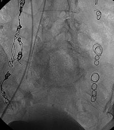 Radiografia abdominal - Embolution