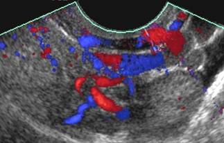 Ultra-som com Doppler - Embolution