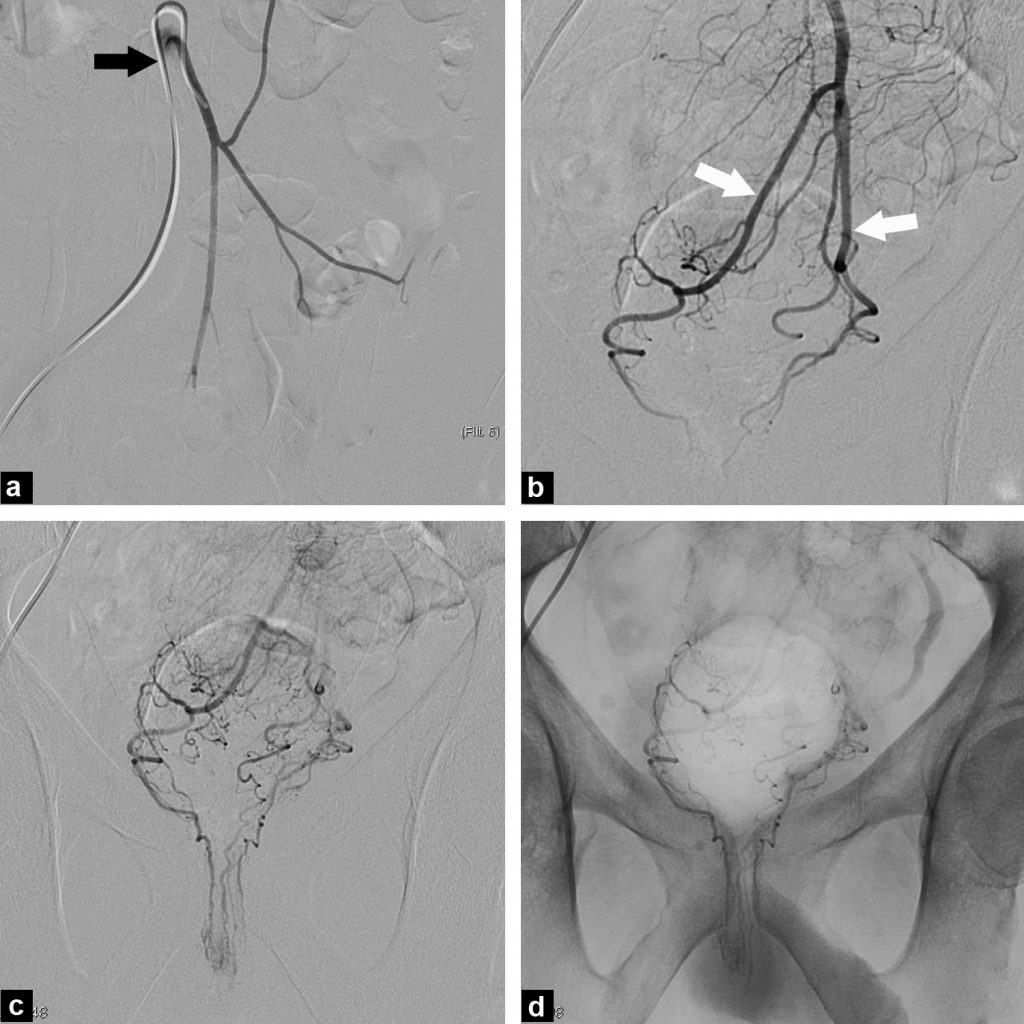 Hemorroidas » Embolution