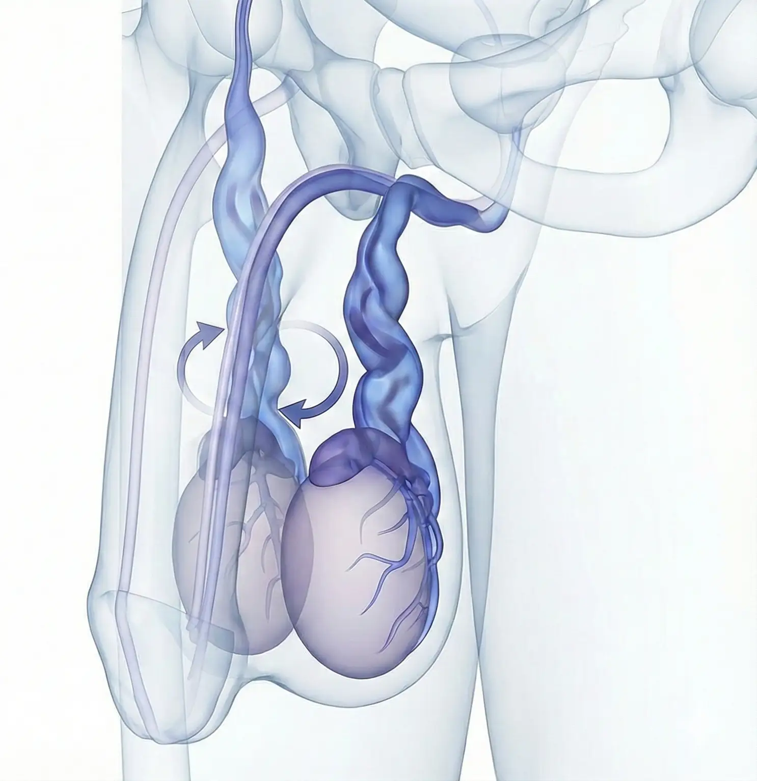 Embolização de Varicocele: Tratamento Minimamente Invasivo, Rápido, Eficiente, Seguro e Sem Cortes.